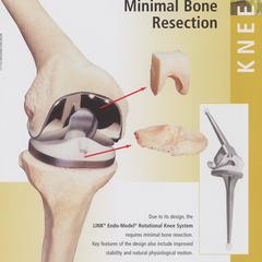 Link Endo-Model Rotation Knee Joint Prosthesis advertisement